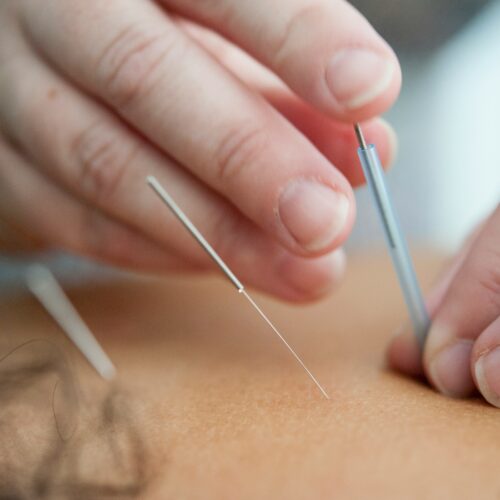 Activist Acupuncture